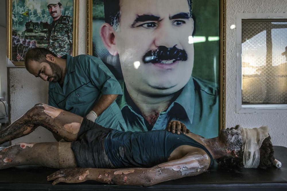 General News 1st place. A doctor rubs ointment on the burns of Jacob, a 16-year-old Islamic State fighter, in front of a poster of Abdullah Ocalan, the jailed leader of the Kurdistan Workers' Party, at a Y.P.G. hospital compound on the outskirts of Hasaka, Syria.